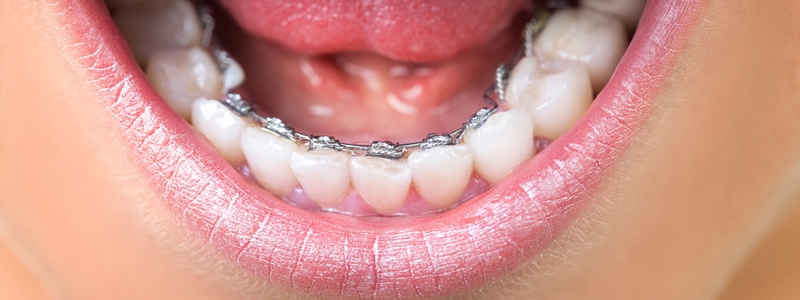 Os aparelhos dentários do futuro